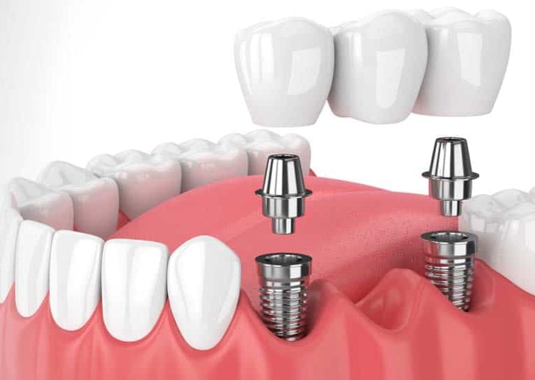 best dental implant specialist in baner