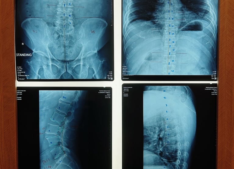 Spinal X-rays for chiropractic analysis of back pain and posture at Sinisana Chiropractic.