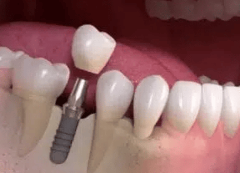diagram of a dental implant