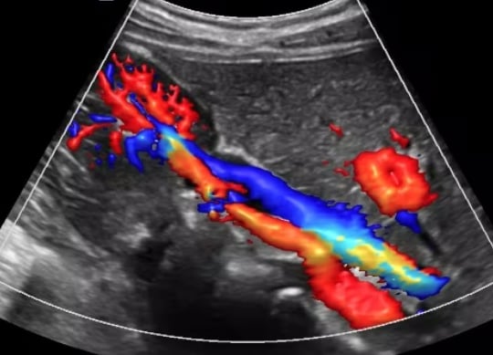 vascular ultrasound renal artery stenosis high blood pressure stent kidney disease function diabetes fibromuscular dysplasia 