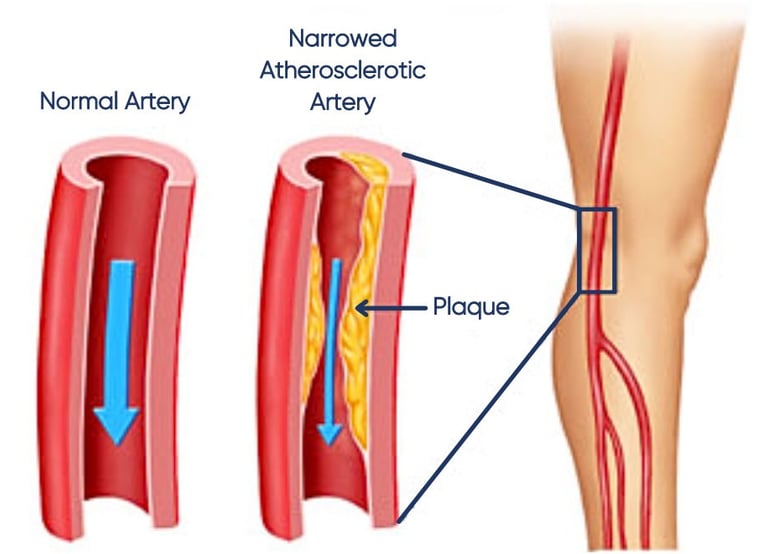 vascular ultrasound artery atherosclerosis stenosis disease stent bypass graft leg pain walking claudication peripheral block