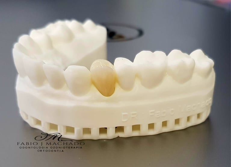 Molde Implante dentário com Dr Fabio Machado, Curitiba Batel