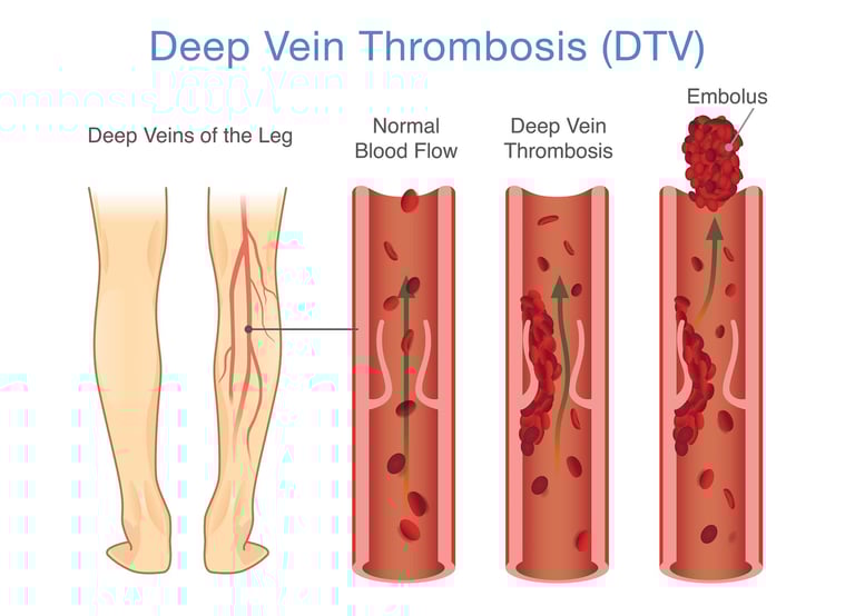 vascular ultrasound blood clot deep vein thrombosis leg swelling thinner anticoagulant embolism pain doppler factor v leiden