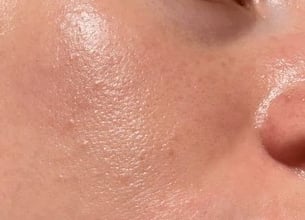 Oily skin sample image