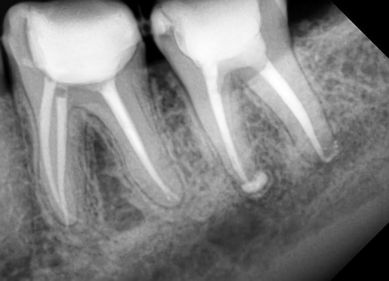 Best root canal treatment done at top dental clinic near Chincholi Malad west in Mumbai