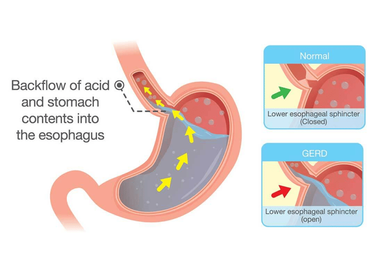savas visszaáramlás