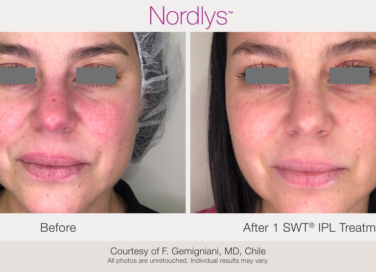 advanced skincare treatment for facial redness and sensitive skin in Hamilton Ontario