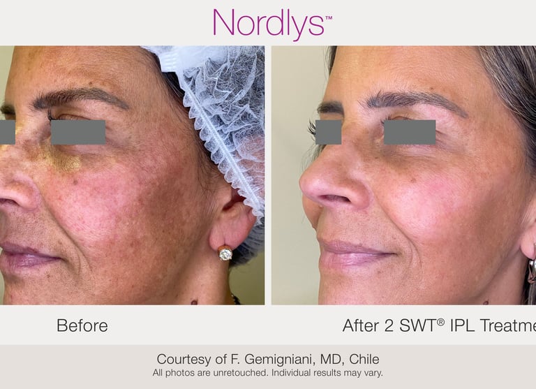 skin brightening and pigmentation correction treatment in Hamilton Ontario