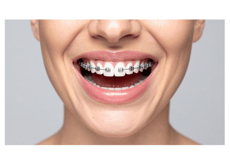 ortodoncia con brackets en gran canaria