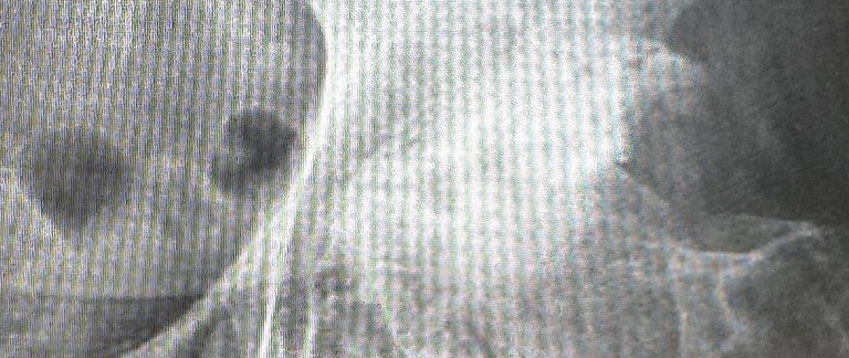 artrosis de cadera