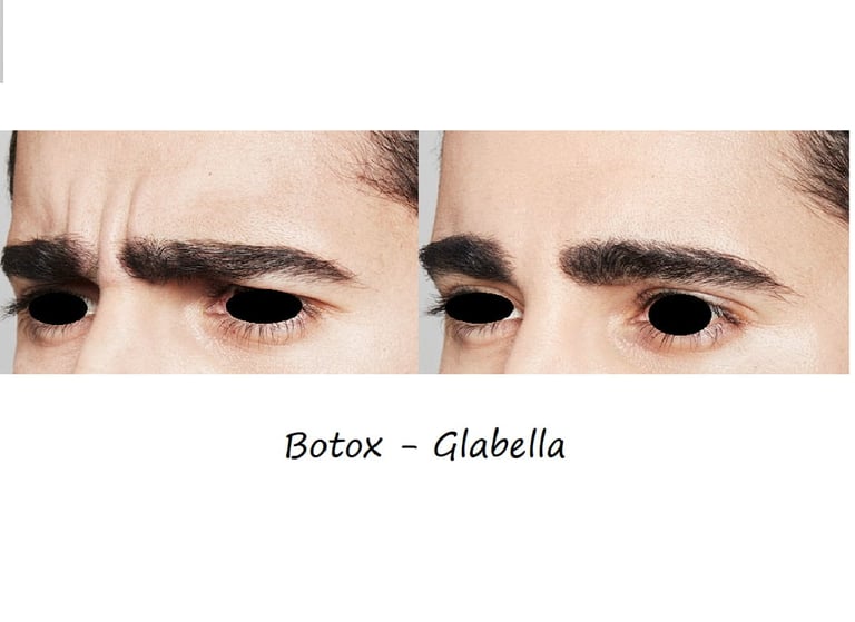 Före- & efterbild botox glabella – slätare bekymmersrynkor och avslappnat, harmoniskt utseende.