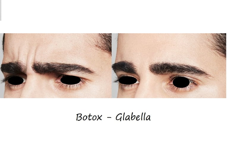 Före- & efterbild botox glabella – slätare bekymmersrynkor och avslappnat, harmoniskt utseende.