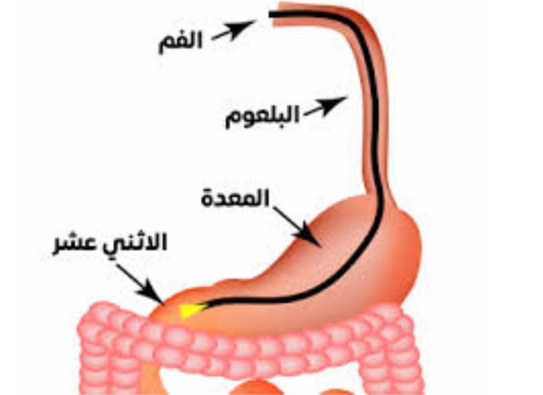 القيء من انسدادات الجهاز الهضمي العلوي