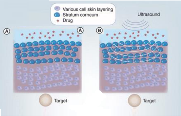 TED uses low-frequency ultrasound waves that creates microbubbles in the scalp