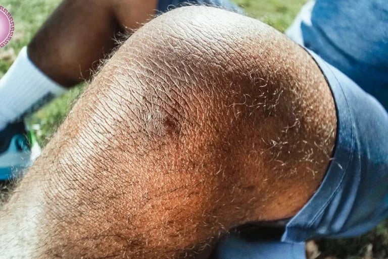 rotura de menisco dónde duele