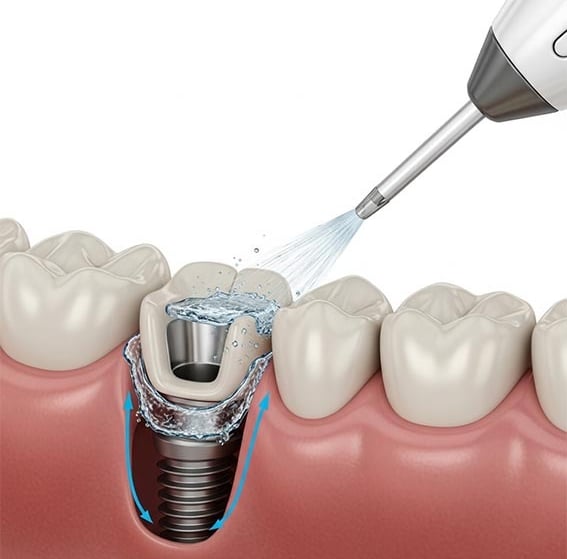 Entretien implant dentaire et hygiène implant dentaire