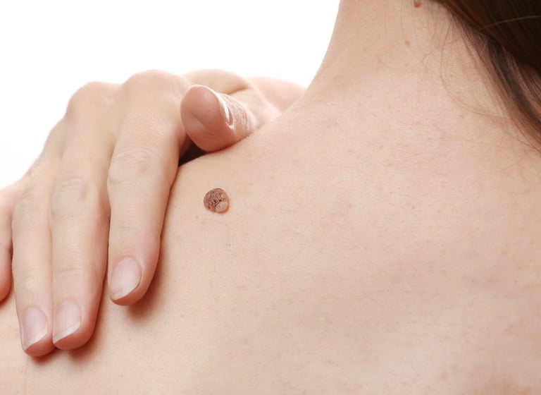 Mole and skin lesion expert assessment in Durham and Darlington at Ash Plastic surgery