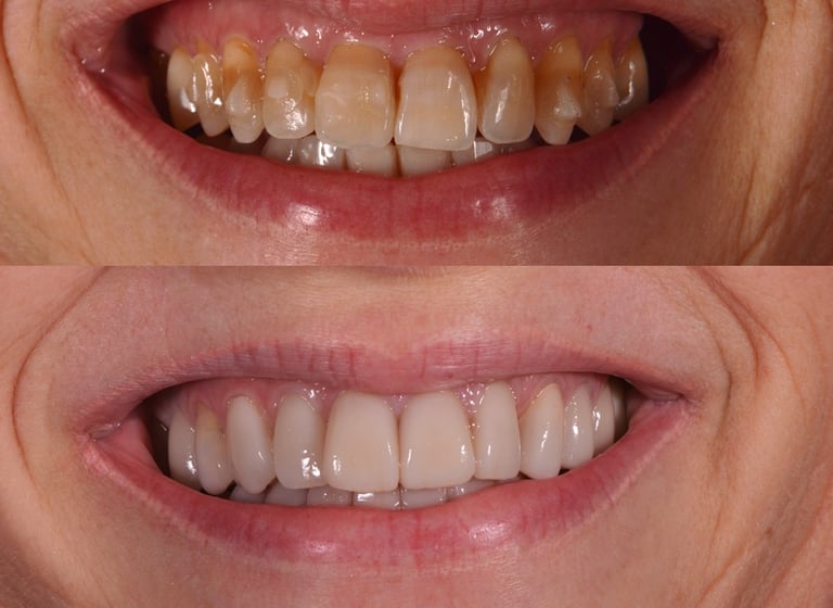 Before and after dental restoration showing yellow stained teeth compared to white porcelain veneers.