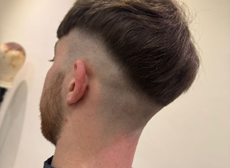 After instant hair Transplant system in Hull by HairLabUK