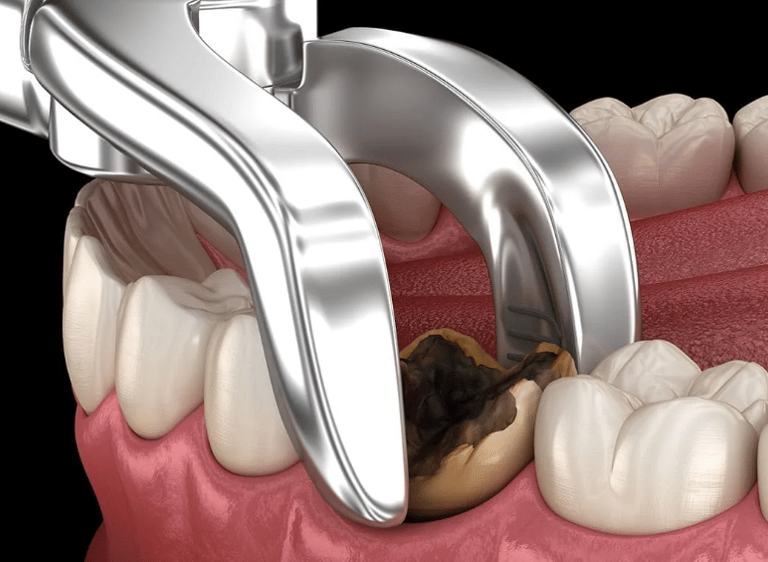 الخلع الجراحي والبسيط
