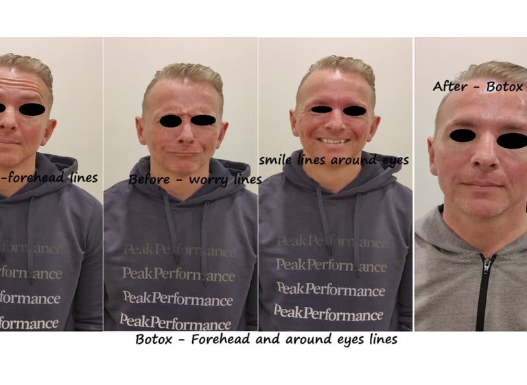 Before and after image of botox in forehead, glabella and around eyes: reduced wrinkles..