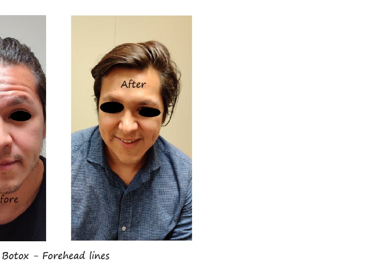 Before and after photos of botox in the forehead - reduced wrinkles and natural eyebrow shape.
