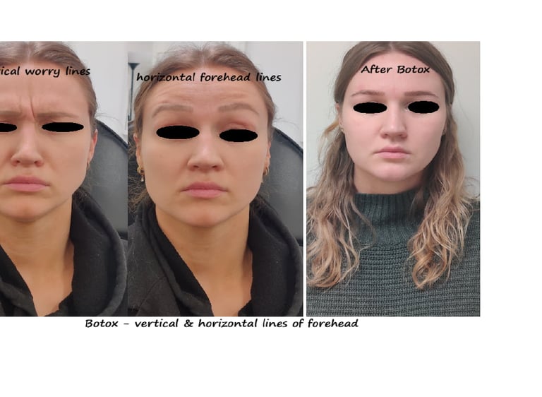 Before and after photos botox forehead and glabella – reduce wrinkles & smoother appearance.