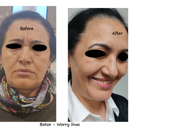 Before & after photos botox worry wrinkles – smoother glabella & relaxed expression.
