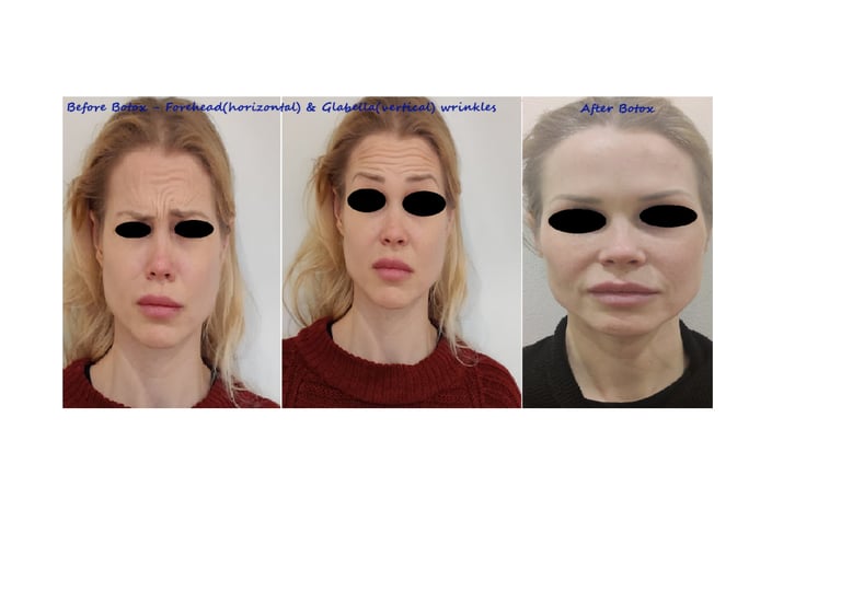 Before and after photos botox forehead and glabella – reduce wrinkles & smoother appearance.
