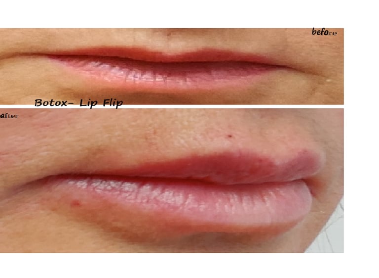 Before and after image of botox lip flip – fuller lips and reduced lines around the mouth.