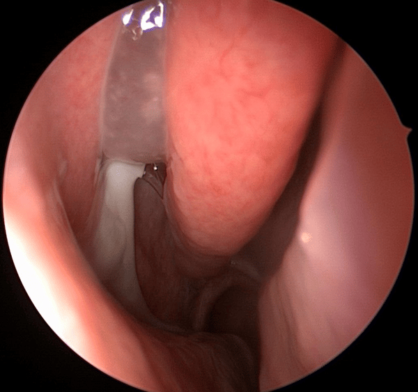 cirurgia endoscópica sinusite