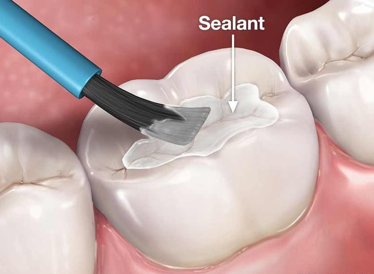 Pit and Fissure Sealant