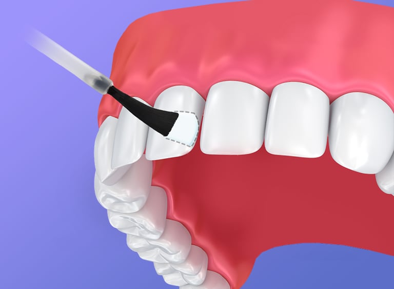 Fluoride Application