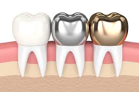 A photo of Dental Bridges and Crowns