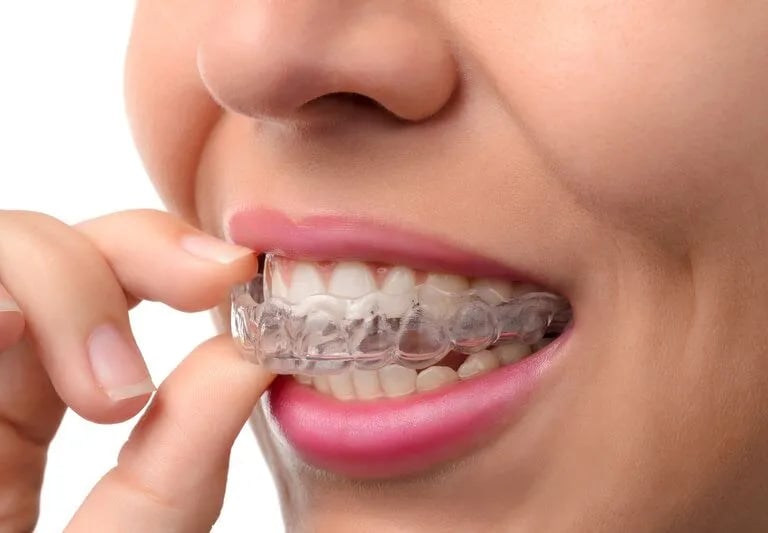 Clear Aligners