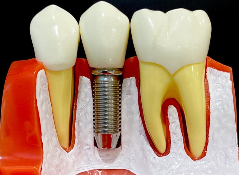 Dental Implants