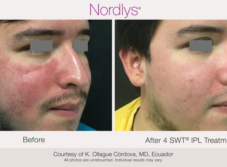 before and after redness and vascular treatment results in Hamilton clinic