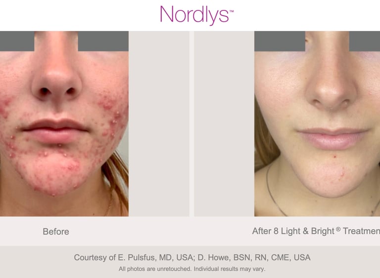 skin improvement after acne scar treatment at Hamilton skincare clinic