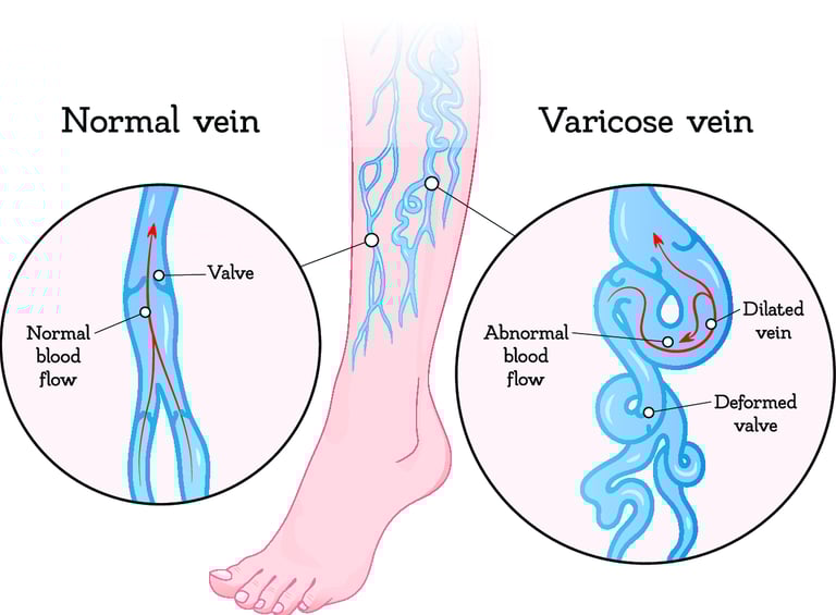 ablation vascular ultrasound varicose vein sclerotherapy radiofrequency laser leg pain swelling ulcer insufficiency chronic