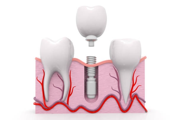 explaining dental implanting procedure diagram