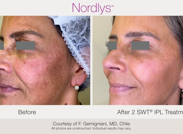 professional skincare consultation for acne and skin concerns in Hamilton clinic