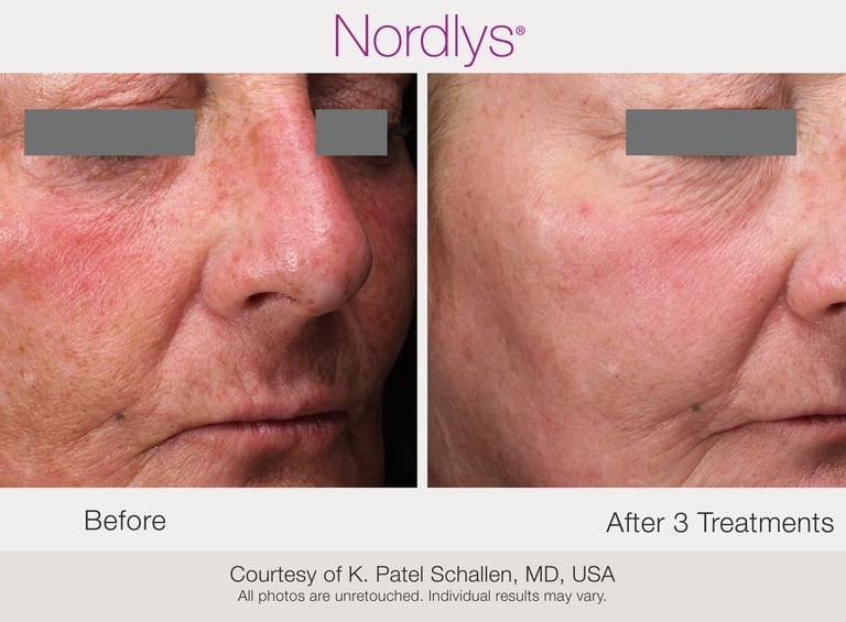 professional redness and vascular skin treatment for rosacea in Hamilton clinic