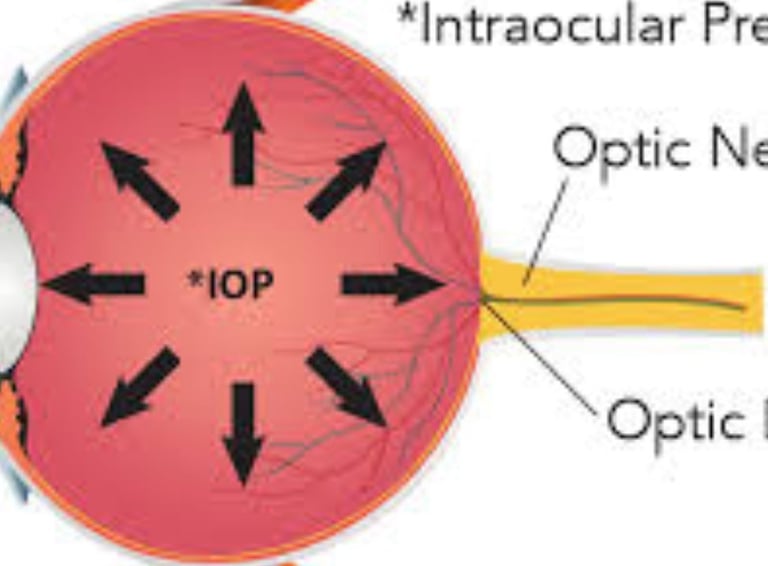 Acute angle-closure glaucoma Severe headache Severe eye pain Nausea or vomiting