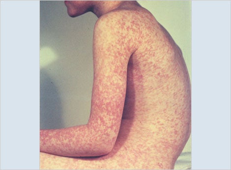 measles case