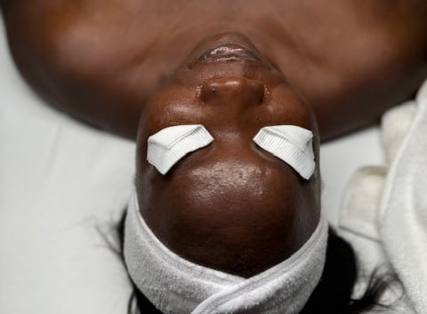 Chemical Peels to brighten and control hyperpigmentation.
