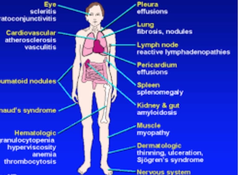 rheumatoid arthritis extra-articular manifestations