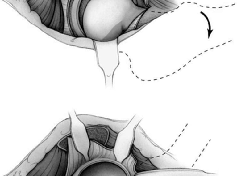 Luxação cirúrgica do quadril.