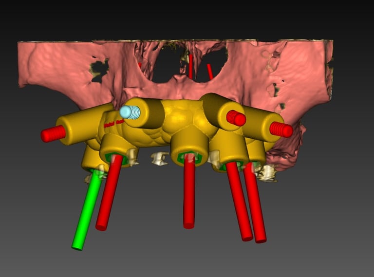 Planificación digital tridimensional para implantes dentales basada en anatomía ósea del paciente