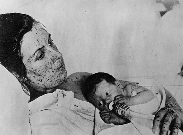 Smallpox