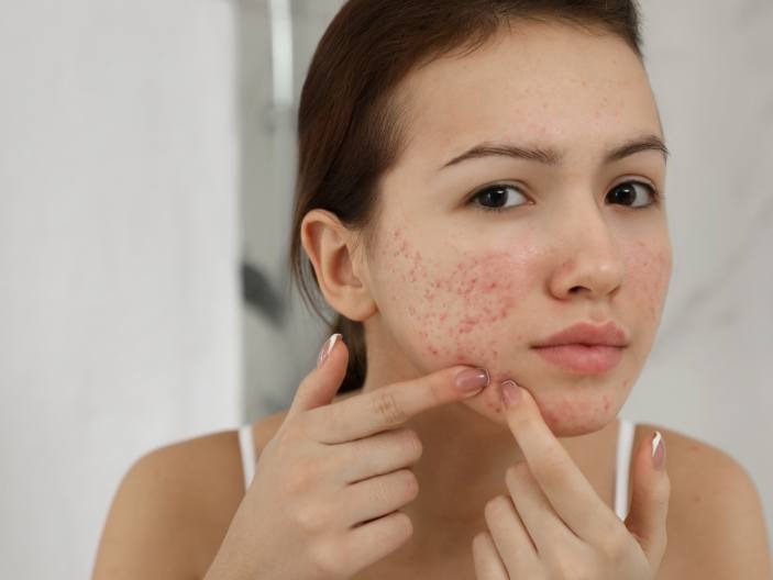 Da mụn dùng toner nào